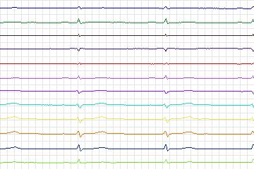 Electrocardiogram for PTB Diagnostic ECG, record s0478_re-patient246
