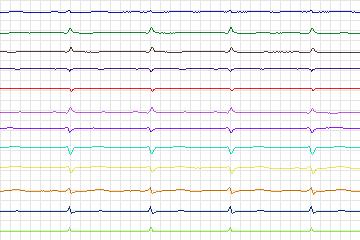 Electrocardiogram for PTB Diagnostic ECG, record s0479_re-patient247