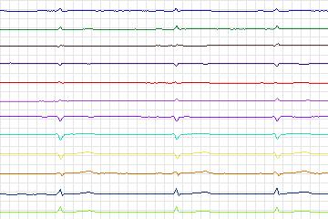 Electrocardiogram for PTB Diagnostic ECG, record s0480_re-patient245