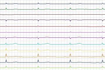 Electrocardiogram for PTB Diagnostic ECG, record s0481_re-patient248