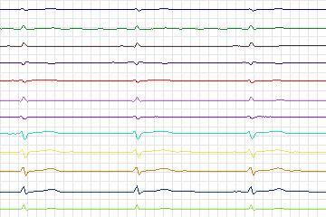 Electrocardiogram for PTB Diagnostic ECG, record s0482_re-patient233