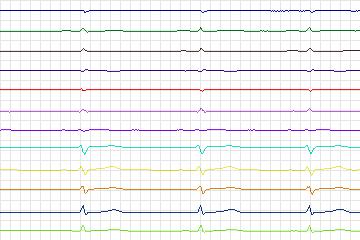 Electrocardiogram for PTB Diagnostic ECG, record s0483_re-patient233
