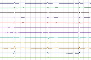 Electrocardiogram for PTB Diagnostic ECG, record s0484_re-patient249