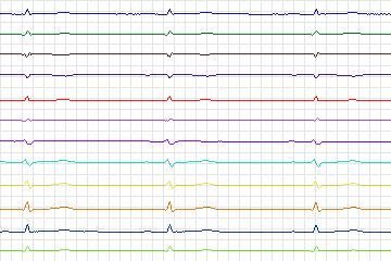 Electrocardiogram for PTB Diagnostic ECG, record s0485_re-patient250