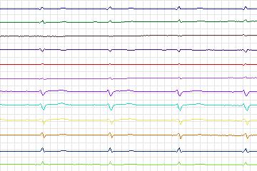 Electrocardiogram for PTB Diagnostic ECG, record s0486_re-patient251