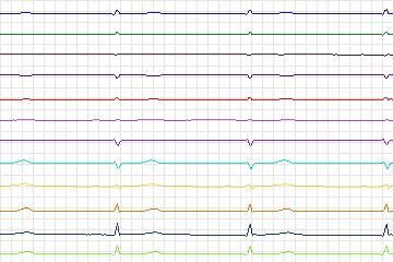 Electrocardiogram for PTB Diagnostic ECG, record s0487_re-patient252