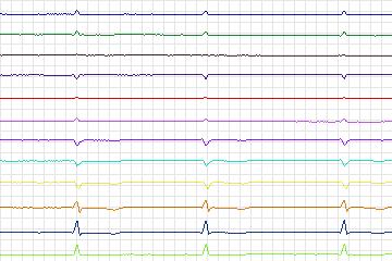Electrocardiogram for PTB Diagnostic ECG, record s0488_re-patient253