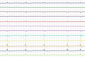 Electrocardiogram for PTB Diagnostic ECG, record s0489_re-patient254