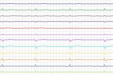 Electrocardiogram for PTB Diagnostic ECG, record s0491_re-patient255