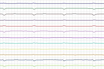 Electrocardiogram for PTB Diagnostic ECG, record s0492_re-patient256
