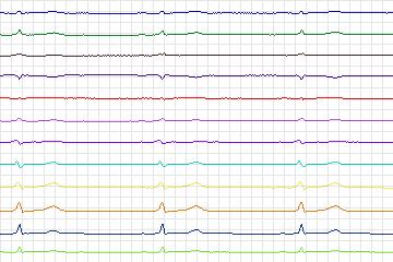 Electrocardiogram for PTB Diagnostic ECG, record s0494_re-patient258