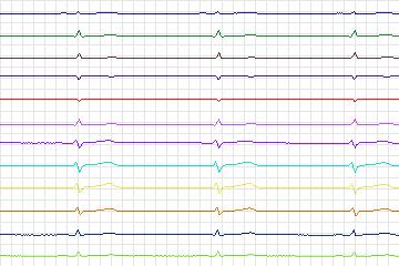 Electrocardiogram for PTB Diagnostic ECG, record s0496_re-patient260