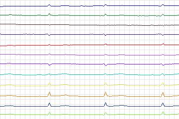 Electrocardiogram for PTB Diagnostic ECG, record s0497_re-patient261