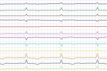 Electrocardiogram for PTB Diagnostic ECG, record s0498_re-patient262