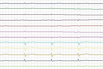 Electrocardiogram for PTB Diagnostic ECG, record s0499_re-patient263