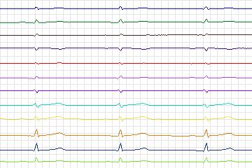 Electrocardiogram for PTB Diagnostic ECG, record s0500_re-patient264