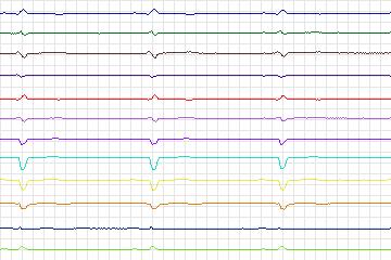Electrocardiogram for PTB Diagnostic ECG, record s0501_re-patient265