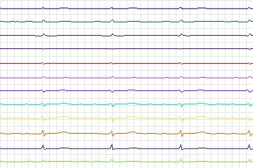 Electrocardiogram for PTB Diagnostic ECG, record s0502_re-patient266