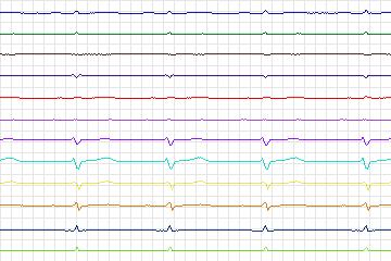 Electrocardiogram for PTB Diagnostic ECG, record s0503_re-patient251