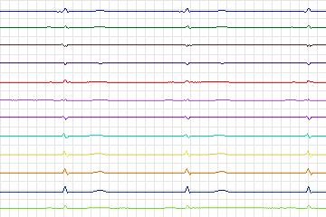 Electrocardiogram for PTB Diagnostic ECG, record s0504_re-patient267