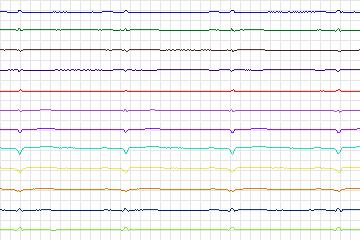 Electrocardiogram for PTB Diagnostic ECG, record s0505_re-patient268