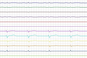 Electrocardiogram for PTB Diagnostic ECG, record s0506_re-patient251