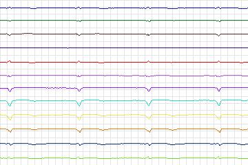 Electrocardiogram for PTB Diagnostic ECG, record s0507_re-patient270