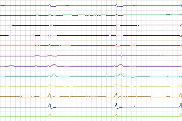 Electrocardiogram for PTB Diagnostic ECG, record s0508_re-patient269