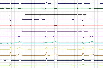 Electrocardiogram for PTB Diagnostic ECG, record s0509_re-patient271