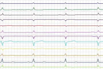 Electrocardiogram for PTB Diagnostic ECG, record s0510_re-patient272