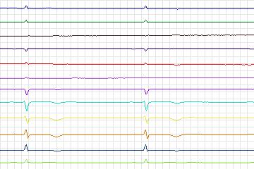 Electrocardiogram for PTB Diagnostic ECG, record s0511_re-patient273
