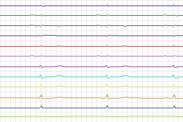 Electrocardiogram for PTB Diagnostic ECG, record s0512_re-patient274