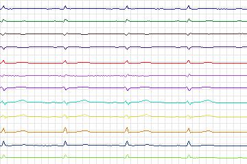 Electrocardiogram for PTB Diagnostic ECG, record s0513_re-patient275
