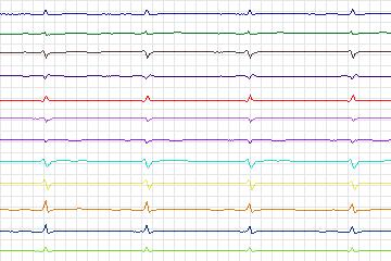 Electrocardiogram for PTB Diagnostic ECG, record s0526_re-patient276