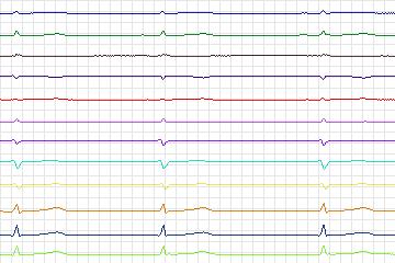 Electrocardiogram for PTB Diagnostic ECG, record s0527_re-patient277