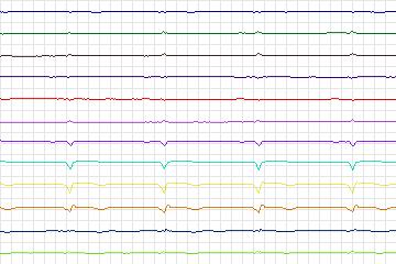 Electrocardiogram for PTB Diagnostic ECG, record s0528_re-patient278