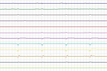 Electrocardiogram for PTB Diagnostic ECG, record s0529_re-patient278