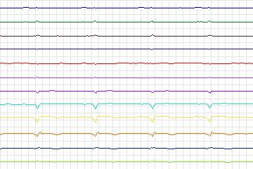 Electrocardiogram for PTB Diagnostic ECG, record s0530_re-patient278