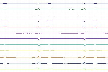 Electrocardiogram for PTB Diagnostic ECG, record s0531_re-patient279