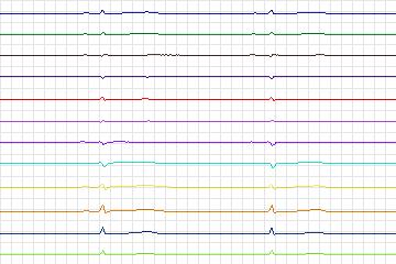 Electrocardiogram for PTB Diagnostic ECG, record s0532_re-patient279