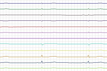 Electrocardiogram for PTB Diagnostic ECG, record s0533_re-patient279