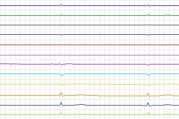 Electrocardiogram for PTB Diagnostic ECG, record s0534_re-patient279
