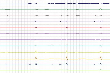 Electrocardiogram for PTB Diagnostic ECG, record s0535_re-patient280