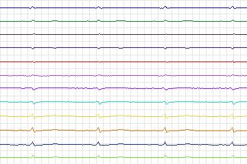 Electrocardiogram for PTB Diagnostic ECG, record s0537_re-patient281