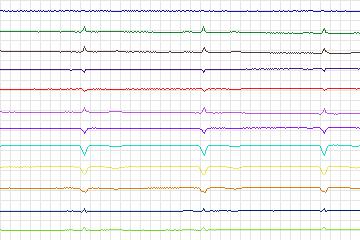 Electrocardiogram for PTB Diagnostic ECG, record s0539_re-patient282