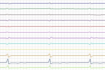 Electrocardiogram for PTB Diagnostic ECG, record s0542_re-patient283