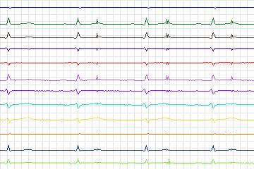 Electrocardiogram for PTB Diagnostic ECG, record s0543_re-patient284