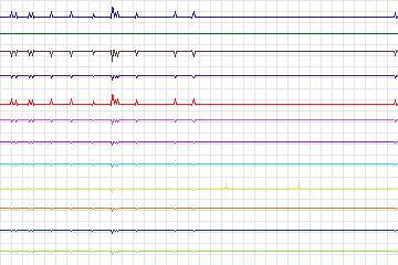 Electrocardiogram for PTB Diagnostic ECG, record s0544_re-patient285
