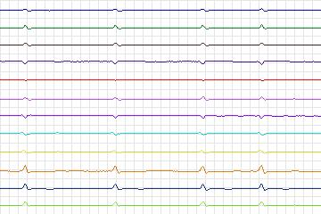 Electrocardiogram for PTB Diagnostic ECG, record s0546_re-patient286
