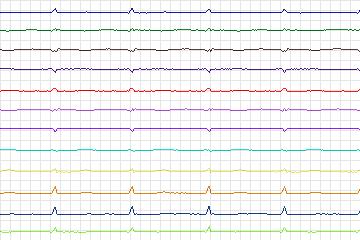 Electrocardiogram for PTB Diagnostic ECG, record s0547_re-patient287